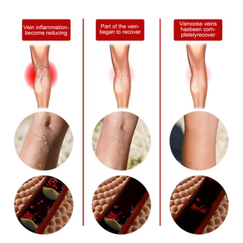 Билкови лечение на разширени вени Балсам за крака 